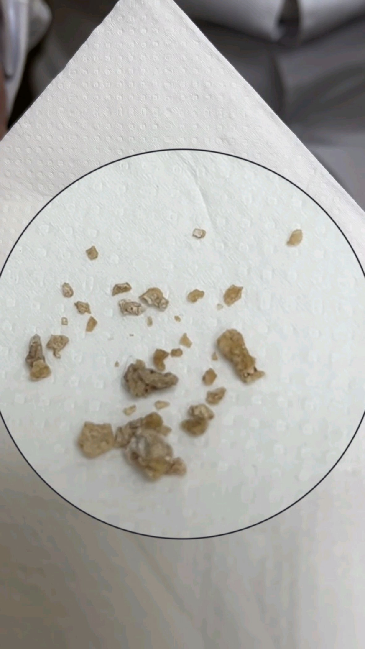 My Kidney Stone Nightmare: How I Survived 2 Painful Attacks & Passed Stones Naturally