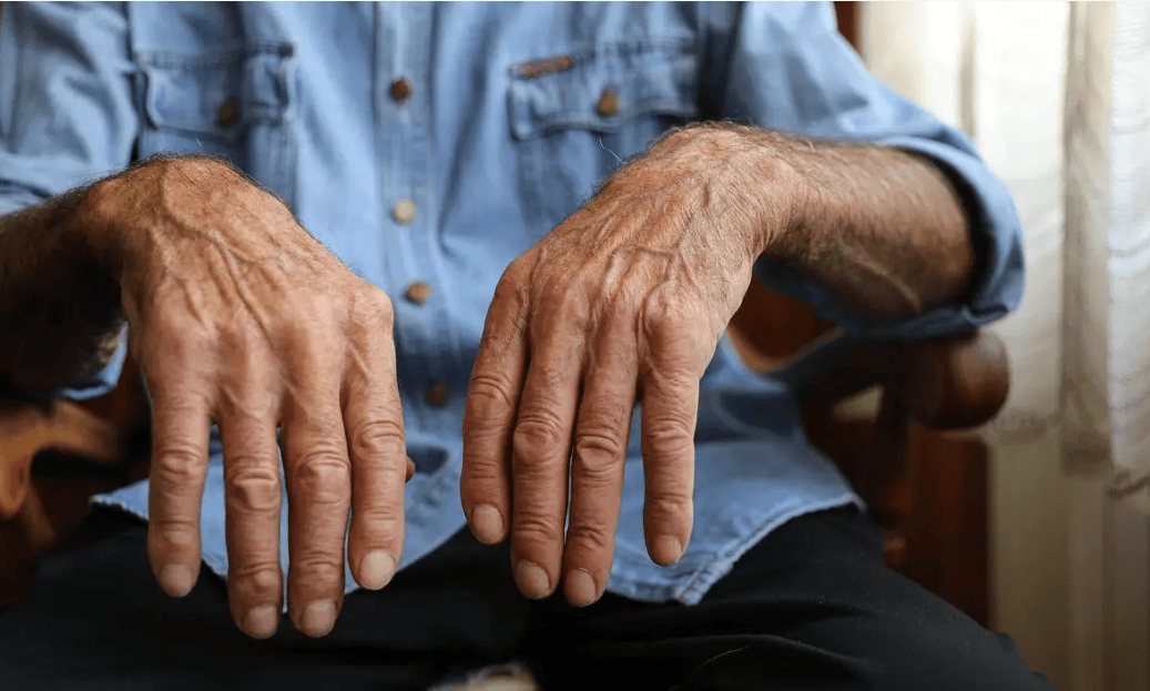 5-Year Study Reveals: Deep Brain Stimulation Maintains Significant Benefits for Parkinson’s Symptoms