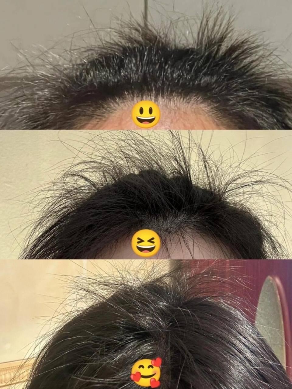 How New Drugs Restore 80% Hair Growth for Alopecia Areata Patients